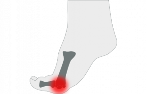 Tratamiento de sesamoiditis