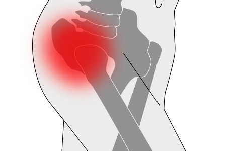 Artrosis de cadera